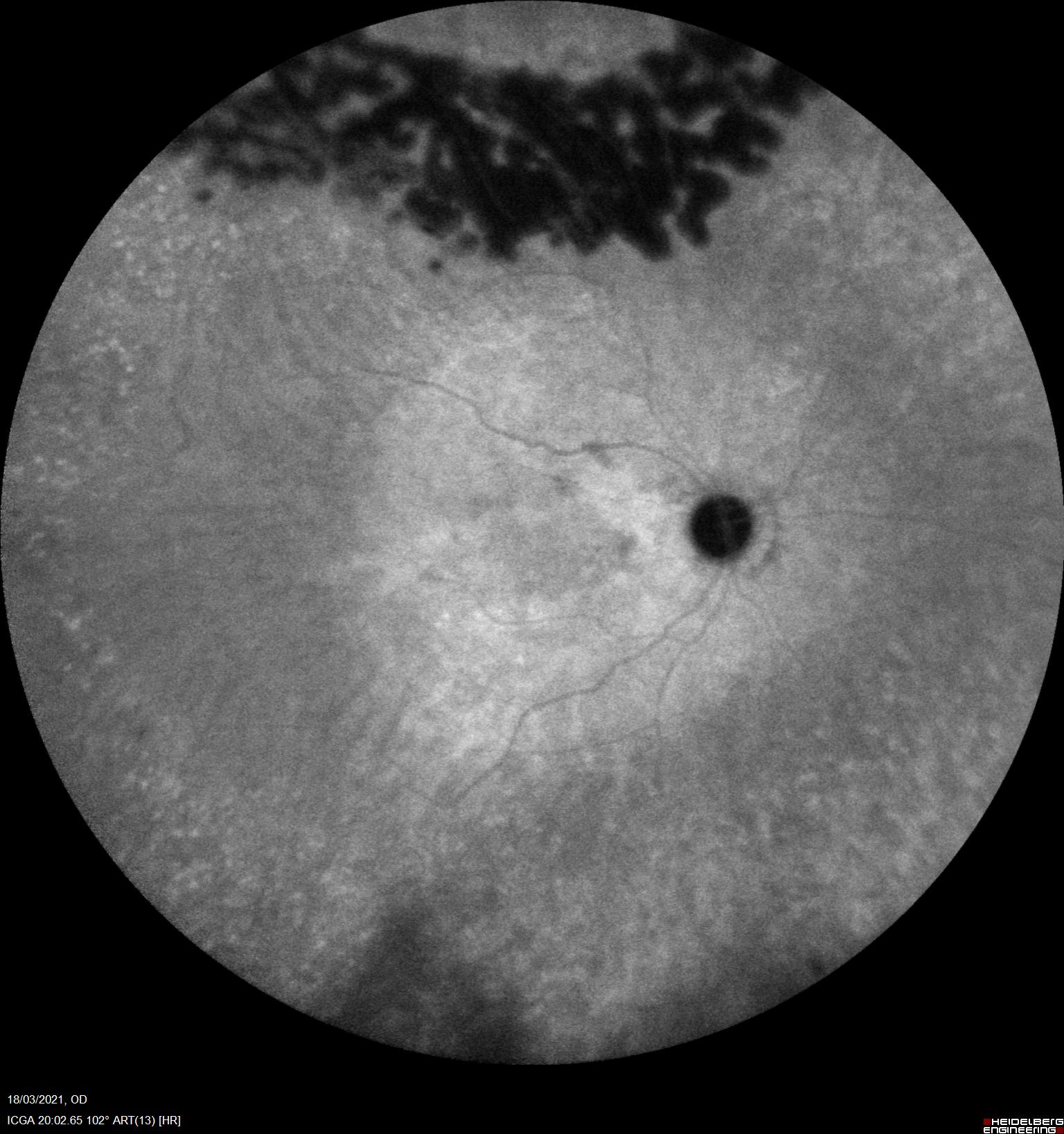 Fenomeno de lavado con isocianescencia tardía enHipercianescencia en hemangioma coroideo